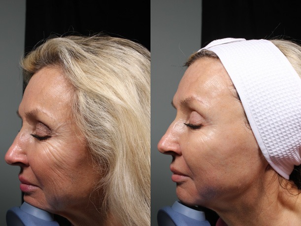 Before-and-after-DermaPen21