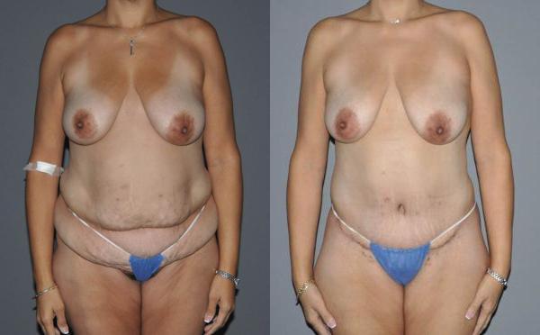 Abdominoplasty Before and After Photo by Dr. Yugueros in Johns Creek Georgia