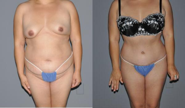 Abdominoplasty Before and After Photo by Dr. Yugueros in Johns Creek Georgia