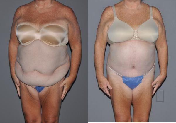 Abdominoplasty Before and After Photo by Dr. Yugueros in Johns Creek Georgia