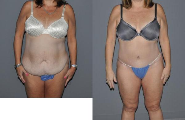 Abdominoplasty Before and After Photo by Dr. Yugueros in Johns Creek Georgia
