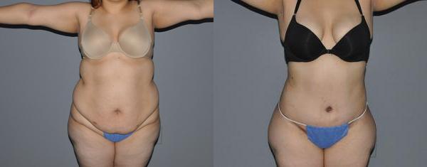 Abdominoplasty Before and After Photo by Dr. Yugueros in Johns Creek Georgia