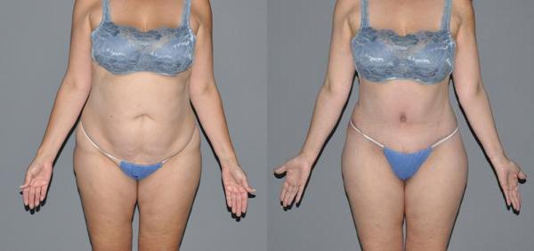 Abdominoplasty Before and After Photo by Dr. Yugueros in Johns Creek Georgia