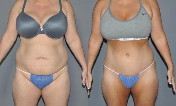 Abdominoplasty Before and After Photo by Dr. Yugueros in Johns Creek Georgia