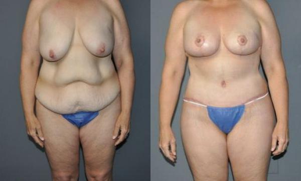 Abdominoplasty Before and After Photo by Dr. Yugueros in Johns Creek Georgia