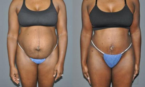 Abdominoplasty Before and After Photo by Dr. Yugueros in Johns Creek Georgia