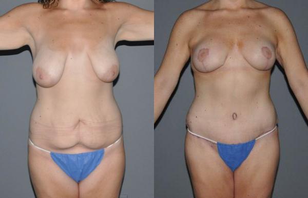 Mommy Makeover Before and After Photo by Dr. Yugueros in Johns Creek Georgia