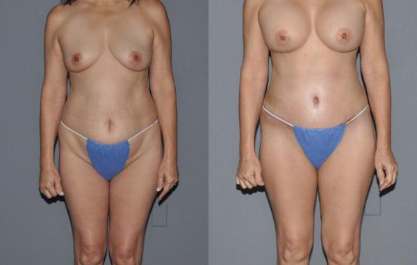 Mommy Makeover Before and After Photo by Dr. Yugueros in Johns Creek Georgia
