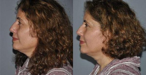 Blepharoplasty Before and After Photo by Dr. Yugueros in Johns Creek Georgia