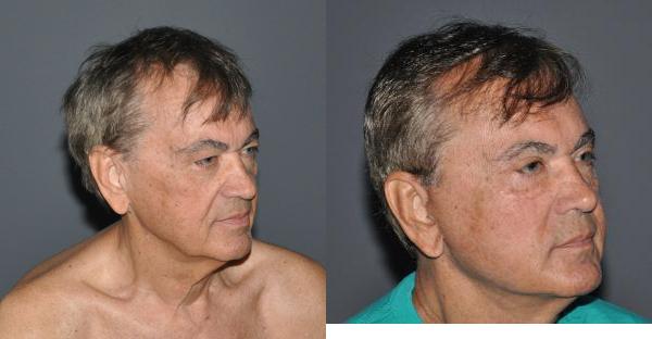 Blepharoplasty Before and After Photo by Dr. Yugueros in Johns Creek Georgia