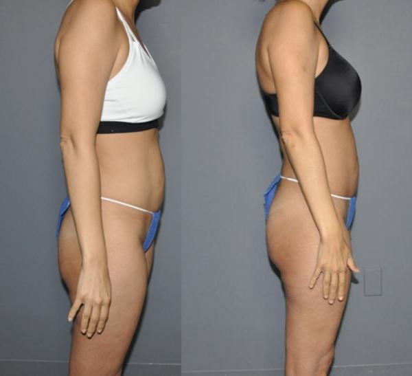 BodyTite Before and After Photo by Dr. Yugueros in Johns Creek Georgia