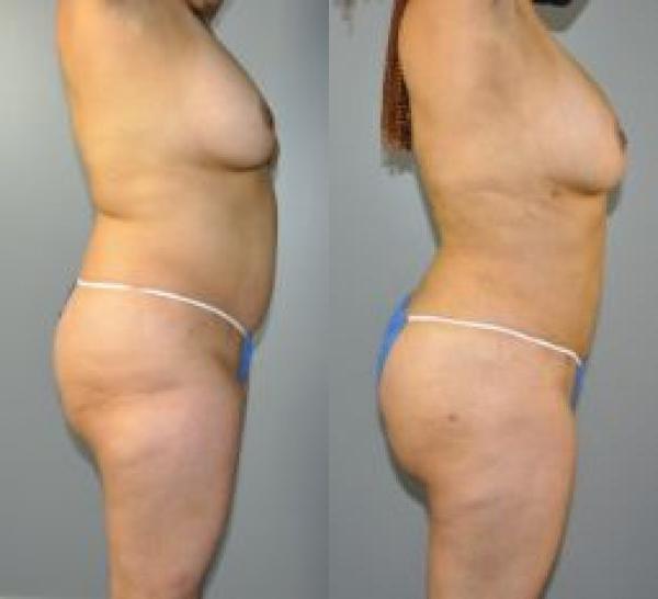 BodyTite Before and After Photo by Dr. Yugueros in Johns Creek Georgia