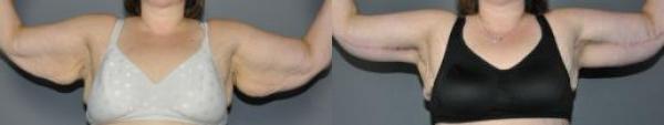 Brachioplasty (Arm Lift) Before and After Photo by Dr. Yugueros in Johns Creek Georgia