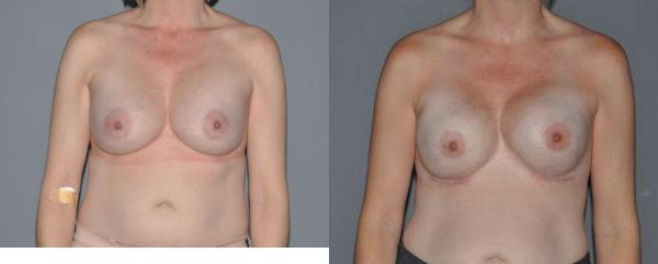 Breast Reconstruction (Breast Cancer) Before and After Photo by Dr. Yugueros in Johns Creek Georgia