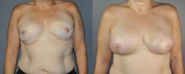 Breast Reconstruction (Breast Cancer) Before and After Photo by Dr. Yugueros in Johns Creek Georgia