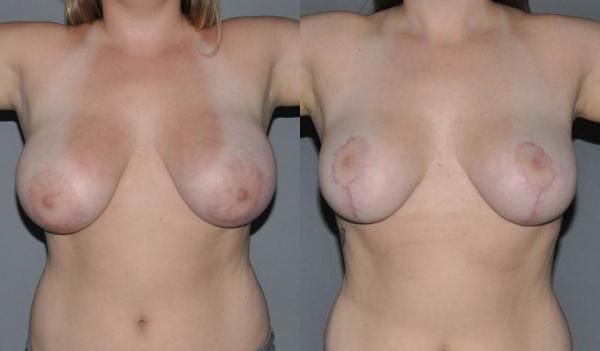 Breast Reduction Before and After Photo by Dr. Yugueros in Johns Creek Georgia