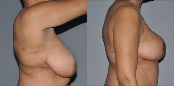 Breast Reduction Before and After Photo by Dr. Yugueros in Johns Creek Georgia