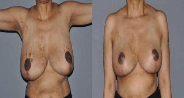 Breast Reduction Before and After Photo by Dr. Yugueros in Johns Creek Georgia