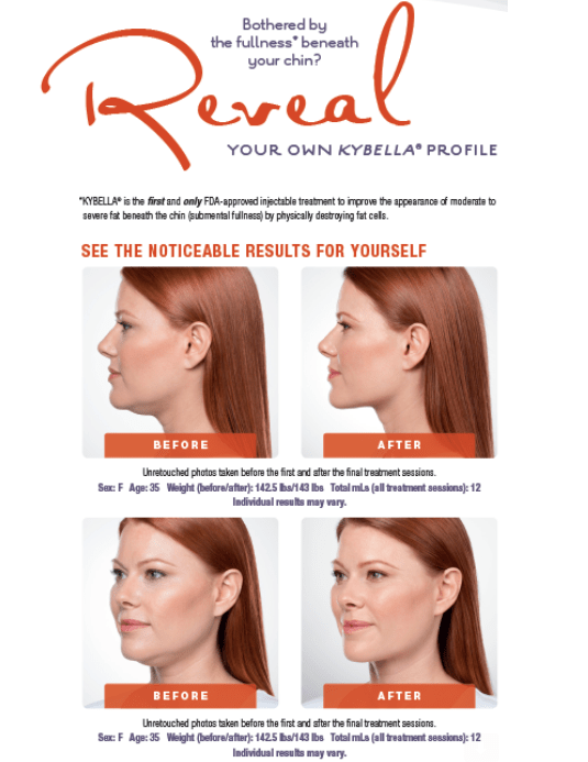 Woman's improved face from Kybella