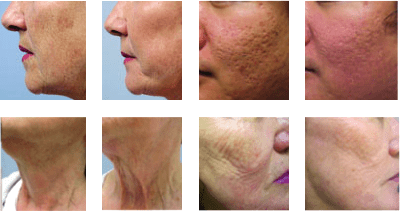 before and after photos that show clear skin after getting the Fractora procedure before and after photos that show clear skin after getting the Fractora procedure