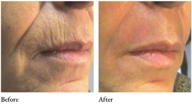 before and after comparison showing a closeup of the lower face having less wrinkles after a coolpeel procedure
