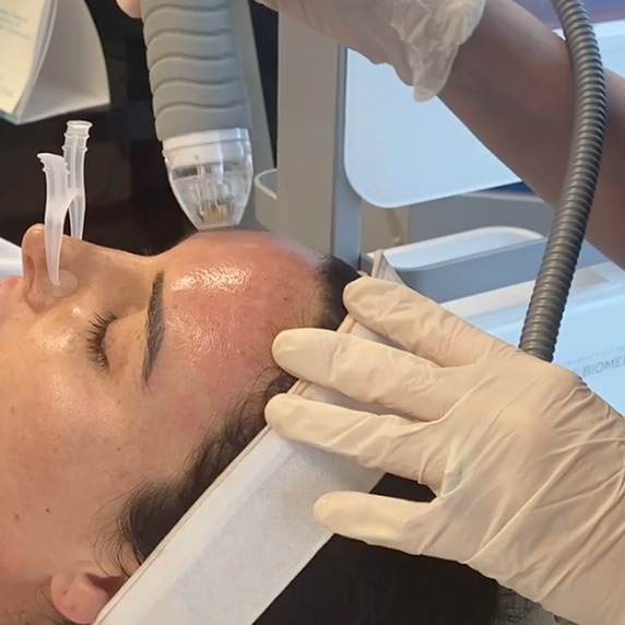 Micropeel procedure performed on forehead