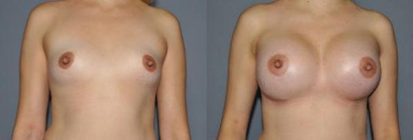 Breast Augmentation Before and After Photo by Dr. Yugueros in Johns Creek Georgia