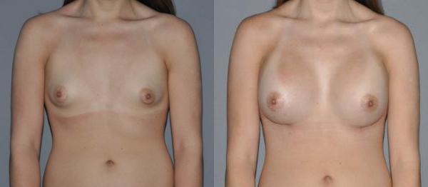 Breast Augmentation Before and After Photo by Dr. Yugueros in Johns Creek Georgia