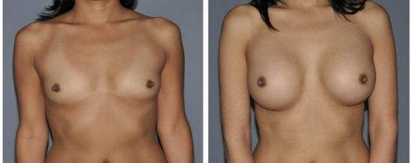 Breast Augmentation Before and After Photo by Dr. Yugueros in Johns Creek Georgia