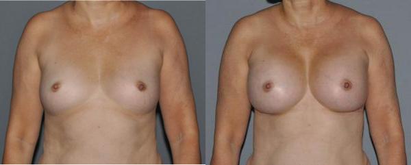 Breast Augmentation Before and After Photo by Dr. Yugueros in Johns Creek Georgia