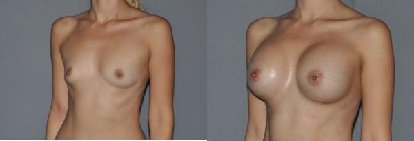 Breast Augmentation Before and After Photo by Dr. Yugueros in Johns Creek Georgia