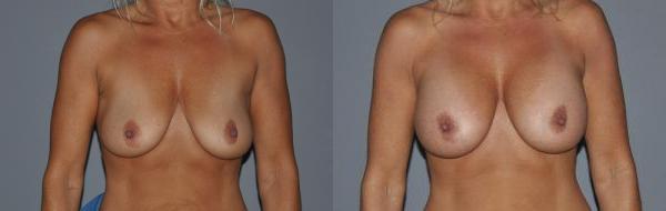 Breast Augmentation Before and After Photo by Dr. Yugueros in Johns Creek Georgia