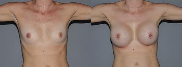 Breast Augmentation Before and After Photo by Dr. Yugueros in Johns Creek Georgia