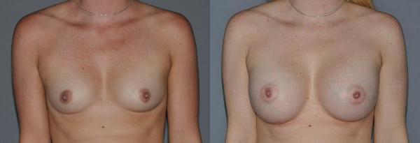 Breast Augmentation Before and After Photo by Dr. Yugueros in Johns Creek Georgia