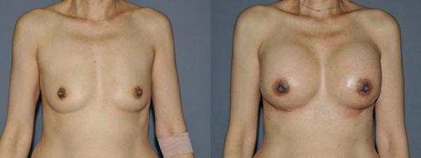 Breast Augmentation Before and After Photo by Dr. Yugueros in Johns Creek Georgia