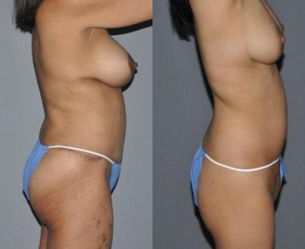 Buttock Augmentation Before and After Photo by Dr. Yugueros in Johns Creek Georgia