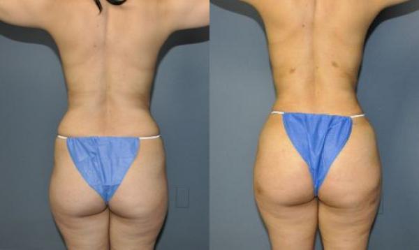 Buttock Augmentation Before and After Photo by Dr. Yugueros in Johns Creek Georgia