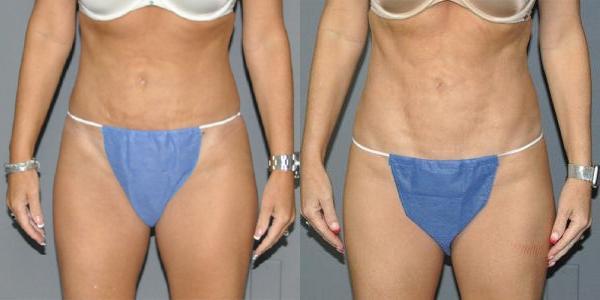 Emsculpt Before and After Photo by Dr. Yugueros in Johns Creek Georgia
