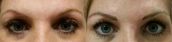 Permanent Make-Up Before and After Photo by Dr. Yugueros in Johns Creek Georgia