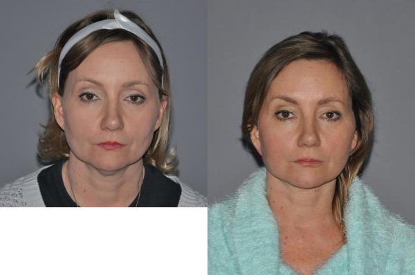 Facelift Before and After Photo by Dr. Yugueros in Johns Creek Georgia