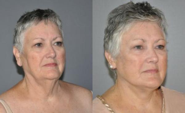 Facelift Before and After Photo by Dr. Yugueros in Johns Creek Georgia