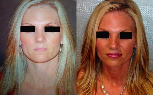 Juvederm Before and After Photo by Dr. Yugueros in Johns Creek Georgia