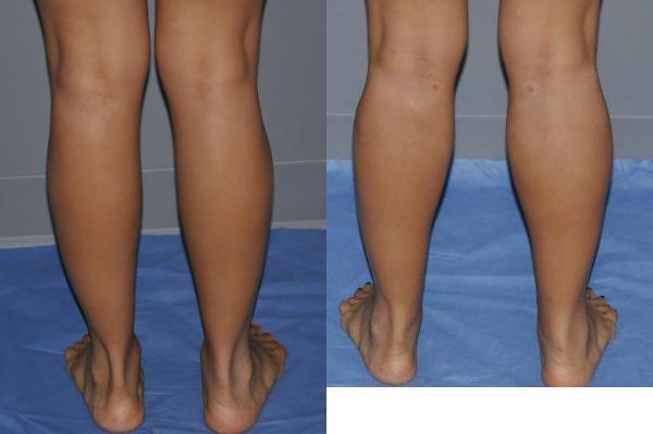 Leg Fat Grafting Before and After Photo by Dr. Yugueros in Johns Creek Georgia