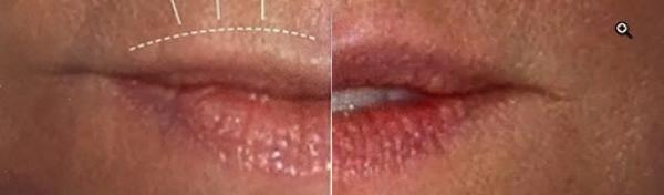 Lip Lift Before and After Photo by Dr. Yugueros in Johns Creek Georgia