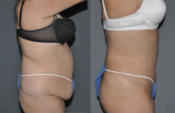 Liposuction Before and After Photo by Dr. Yugueros in Johns Creek Georgia
