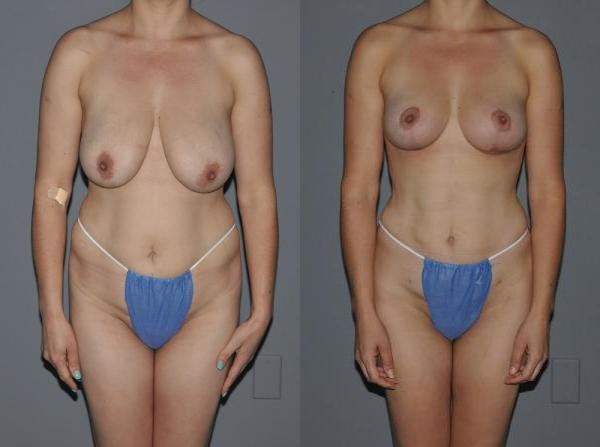 Liposuction Before and After Photo by Dr. Yugueros in Johns Creek Georgia