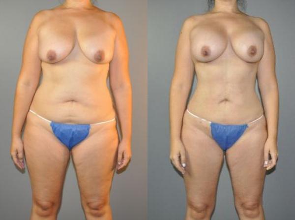 Before and After Breast Augmentation Procedure - Front