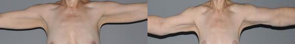 Laser Liposuction Before and After Photo by Dr. Yugueros in Johns Creek Georgia
