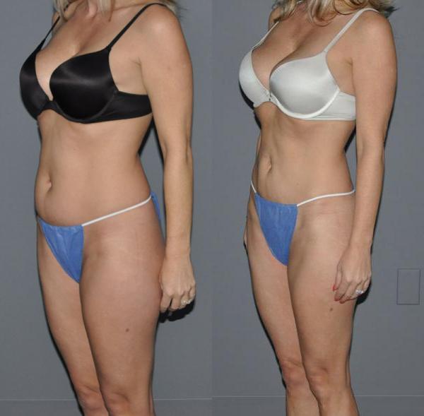Laser Liposuction Before and After Photo by Dr. Yugueros in Johns Creek Georgia