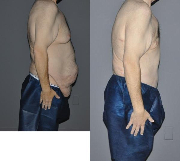 Male Abdominoplasty Before and After Photo by Dr. Yugueros in Johns Creek Georgia